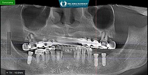 Hành trình niềng răng 3 năm của khách hàng Nguyễn Thị Hồng Nhung