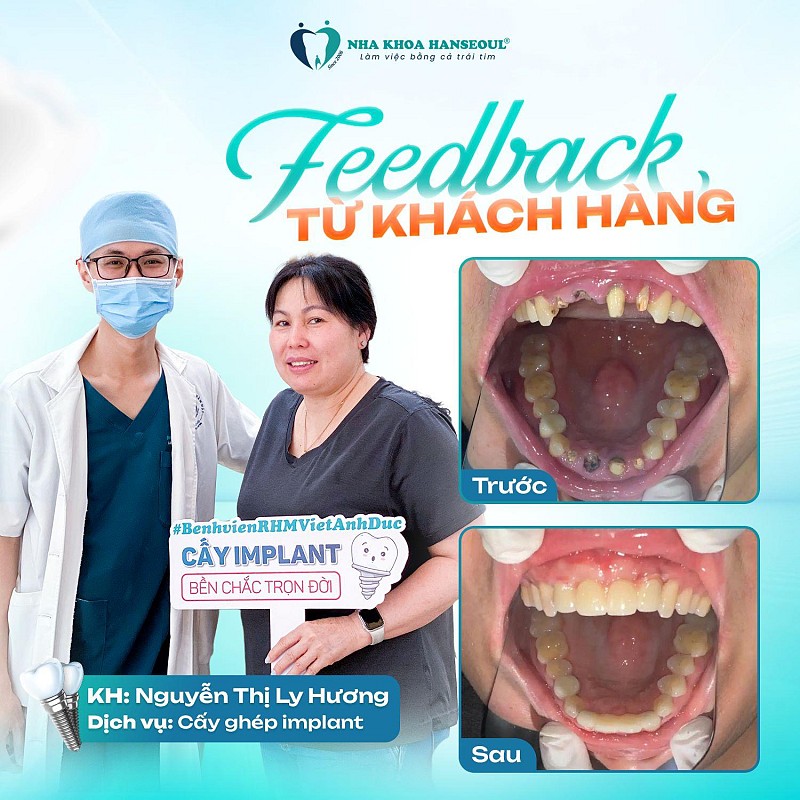 Bọc sứ nhiều lần nhưng vẫn rơi – Cuối cùng tôi đã tìm được giải pháp bền vững cho vùng răng cửa Bọc sứ nhiều lần nhưng vẫn rơi – Cuối cùng tôi đã tìm được giải pháp bền vững cho vùng răng cửa