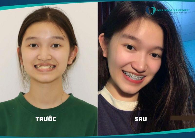 Niềng răng khớp cắn ngược – Màn “lột xác” ngoạn mục của cô gái 18 tuổi Niềng răng khớp cắn ngược – Màn “lột xác” ngoạn mục của cô gái 18 tuổi