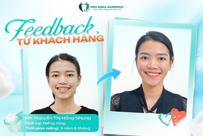 Hành trình niềng răng 3 năm của khách hàng Nguyễn Thị Hồng Nhung Hành trình niềng răng 3 năm của khách hàng Nguyễn Thị Hồng Nhung