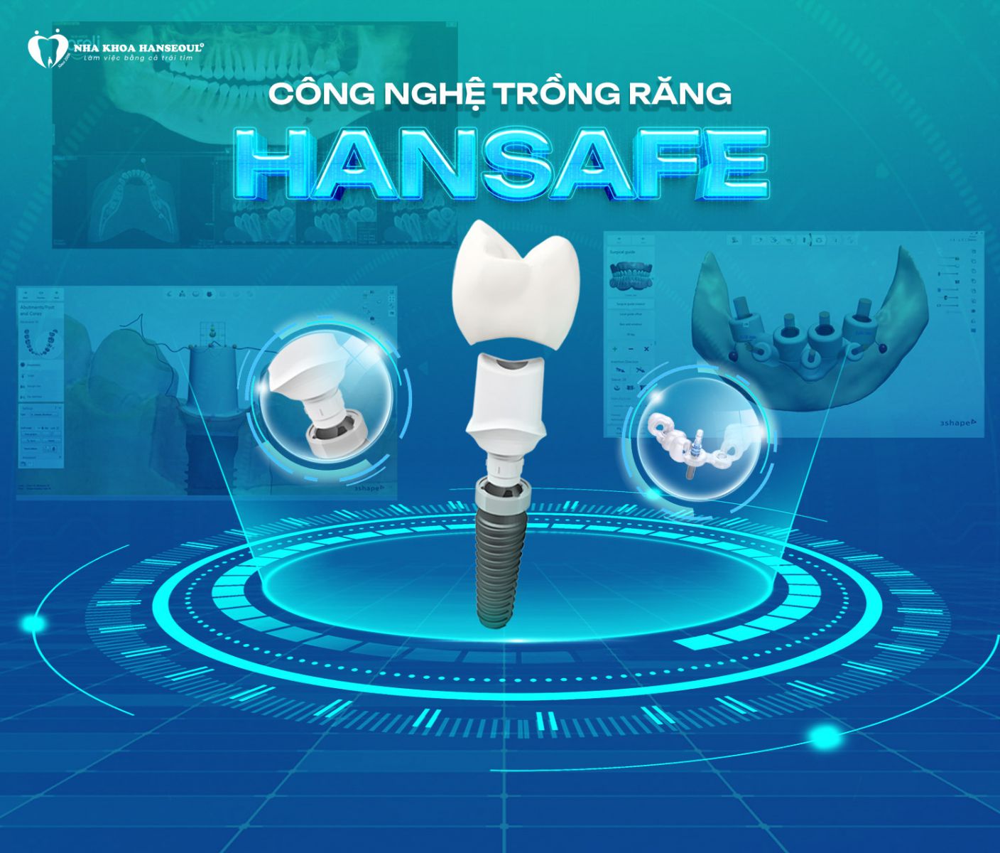 Trồng răng Implant