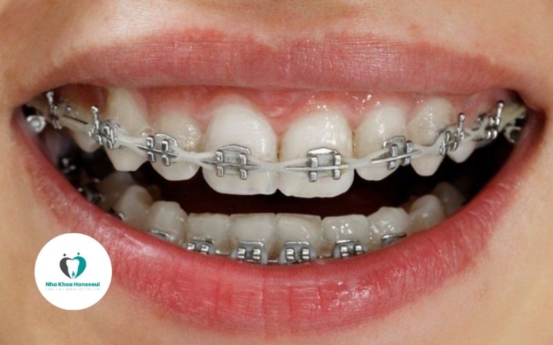 nieng-rang-mac-cai-kim-loai niềng răng mắc cài kim loại là gì