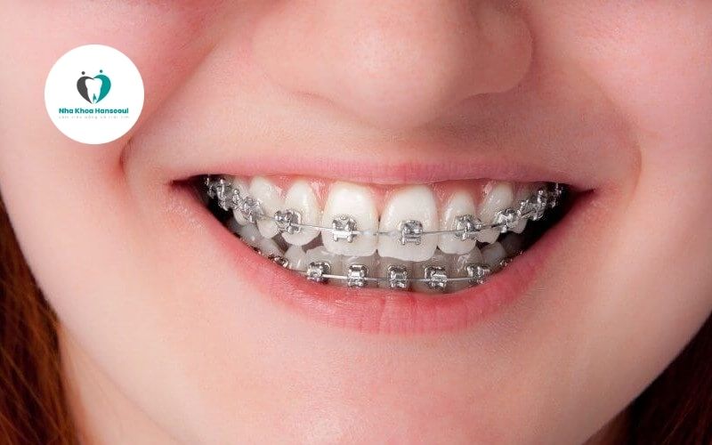 dieu-tri-khop-can-ho điều trị khớp căn hở bằng cách niềng răng