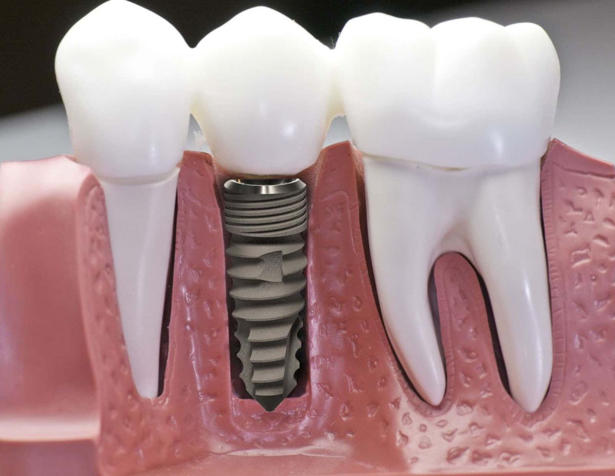 rang-gia-implant