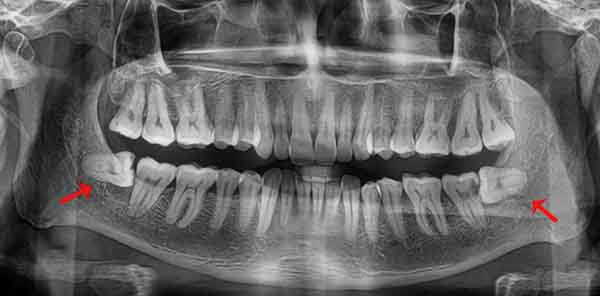 Chụp X-quang trước khi nhổ răng khôn