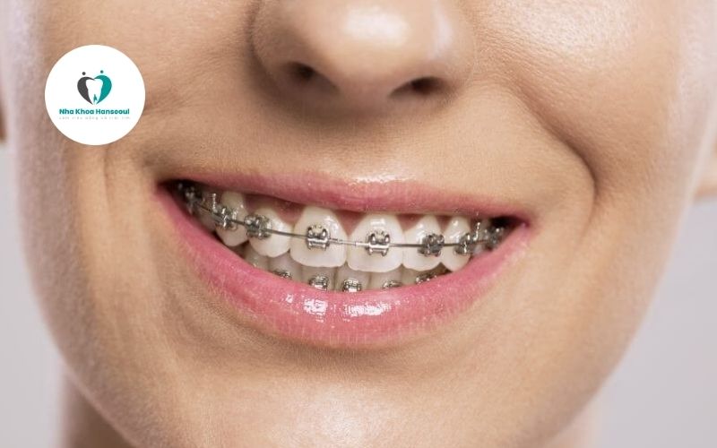 luu-y-nieng-rang-mac-cai-kim-loai Lưu ý khi niềng răng mắc cài kim loại