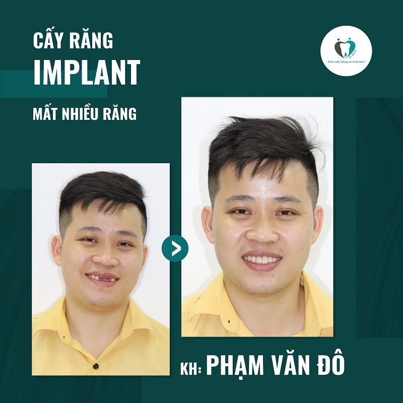 Trước và sau khi trồng răng Implant tại nha khoa Hanseoul