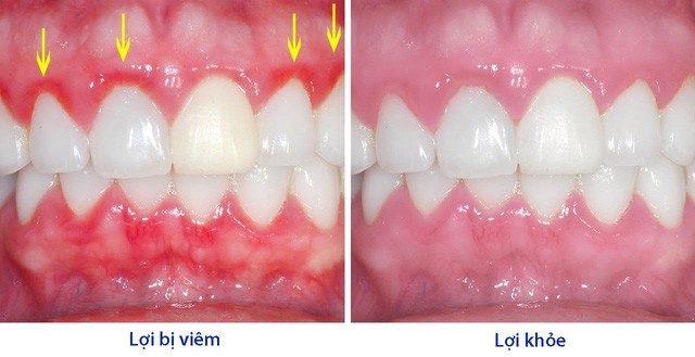 Bệnh viêm lợi