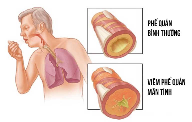 Bệnh viêm phế quản
