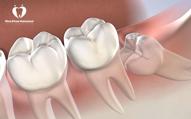 Biến chứng răng khôn mọc lệch