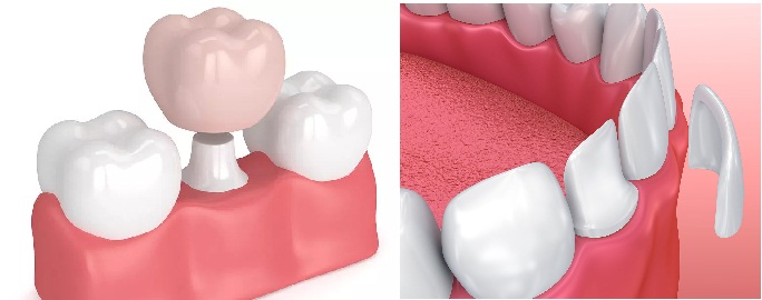 Bọc răng sứ và dán sứ veneer