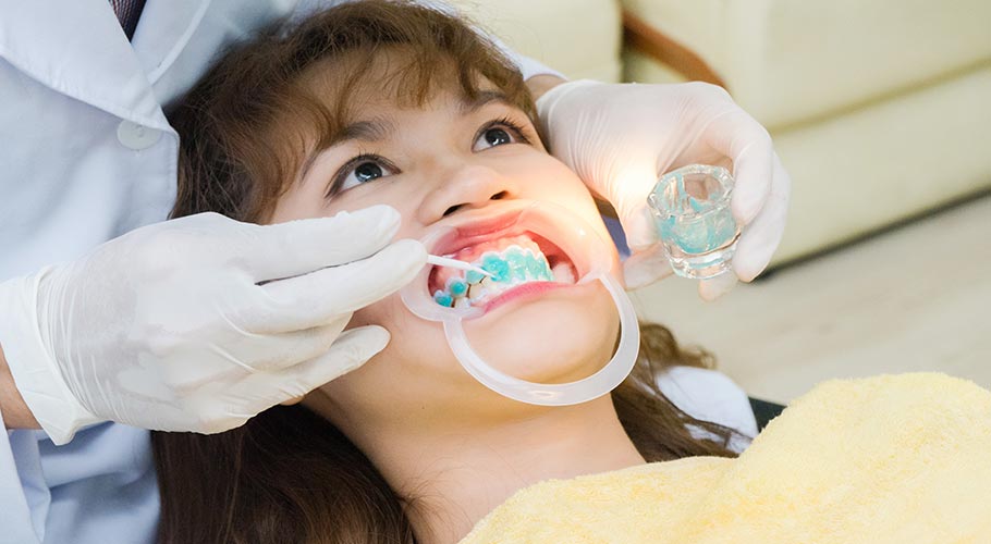 Bôi thuốc tẩy trắng răng