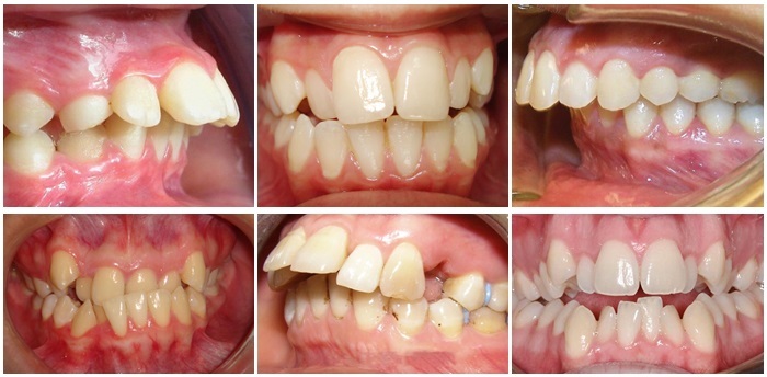 Các kiểu răng mọc lệch