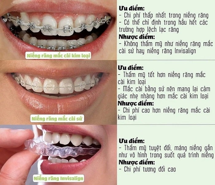 Các loại mắc cài niềng răng