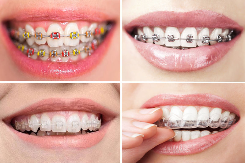 Các loại niềng răng mắc cài phổ biến