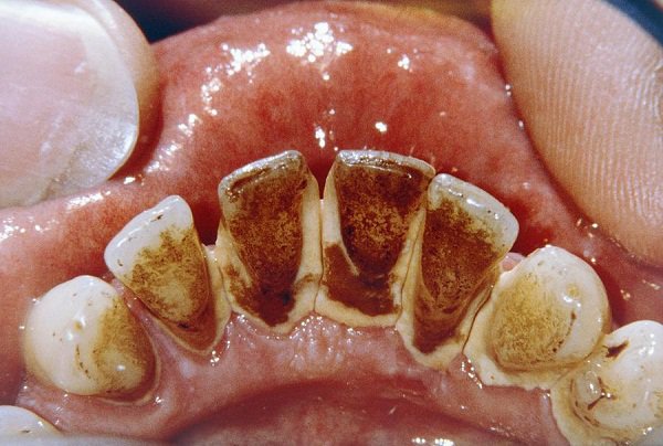 Cao răng được hiểu như thế nào