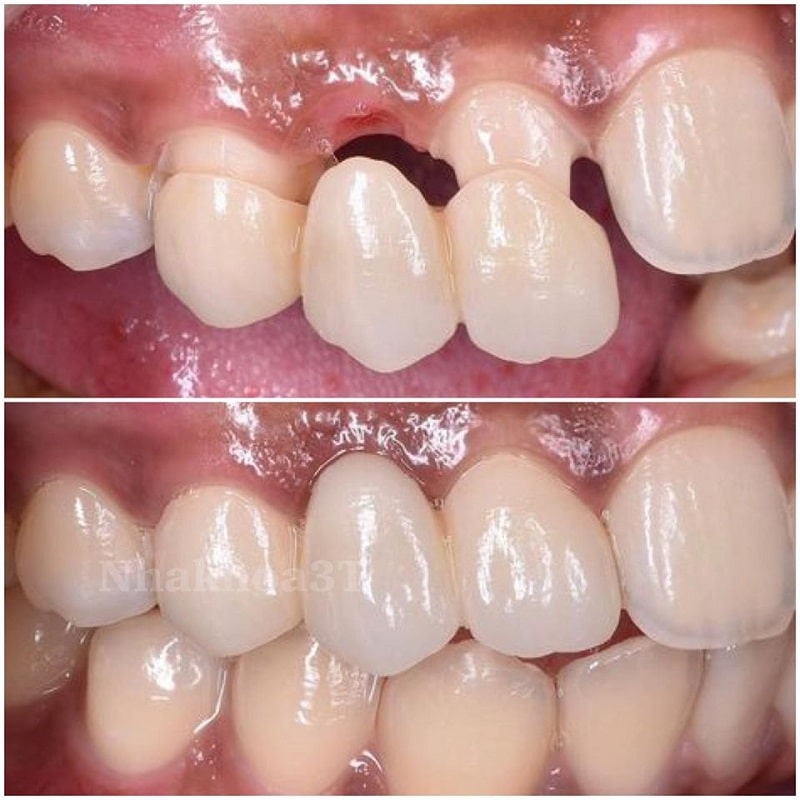 Cầu răng sứ cho bệnh nhân