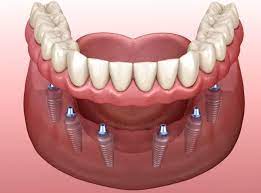 cay-ghep-rang-implant