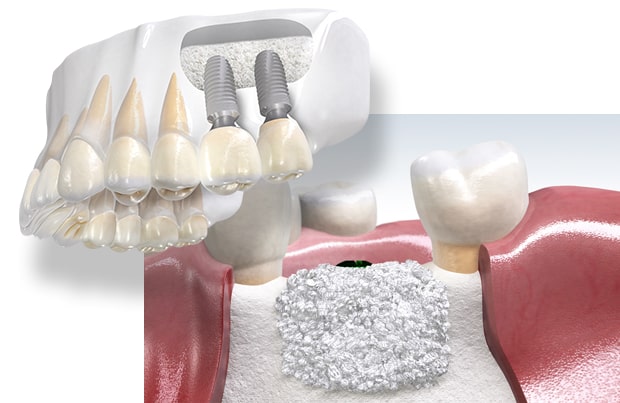 Cấy ghép xương trồng răng
