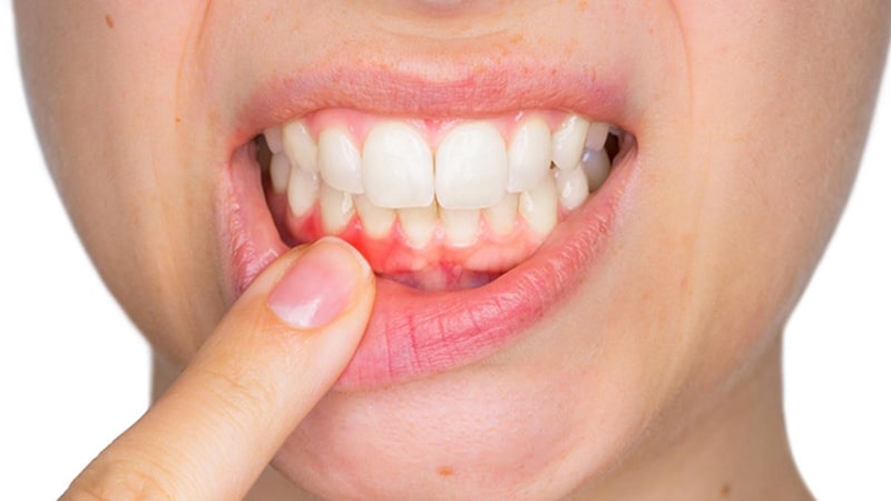 Điều trị bệnh viêm lợi
