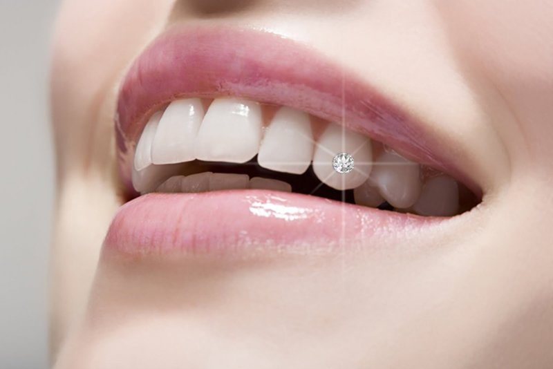 Gắn đá kim cương lên răng
