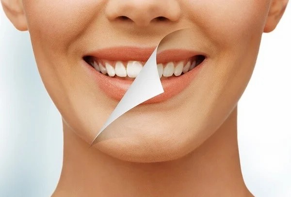 Hiểu về tẩy trắng răng