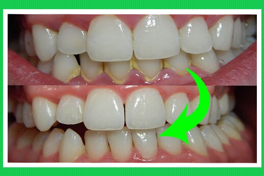 Hình ảnh khi lấy cao răng xong