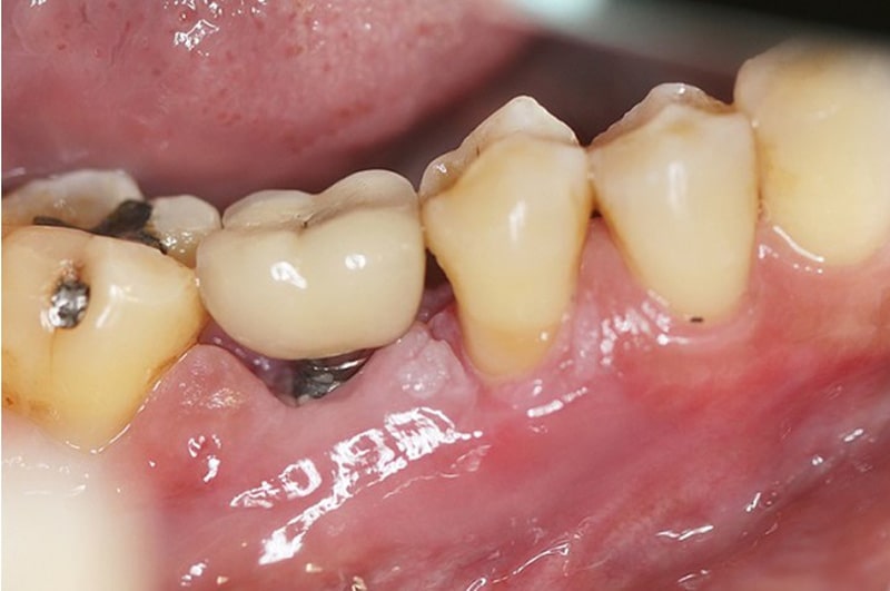 Hình ảnh trồng răng implant giá rẻ