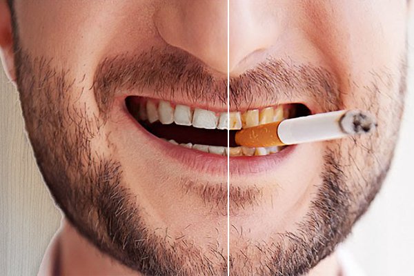 Hút thuốc ảnh hưởng men răng