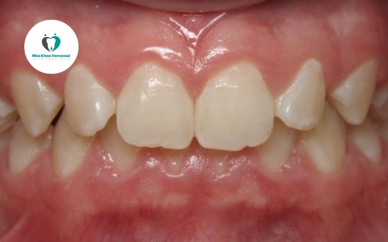 tac-hai-khop-can-sau Hậu quả khớp cắn sâu