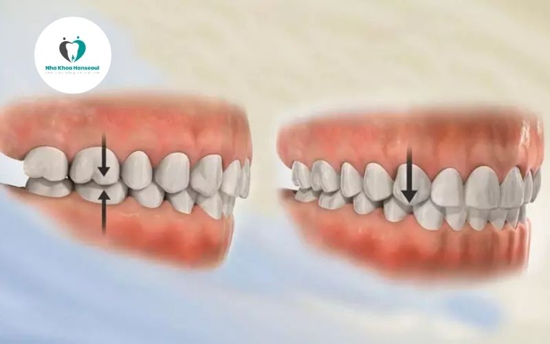 khop-can-sau-la-gi Khớp cắn sâu là gì