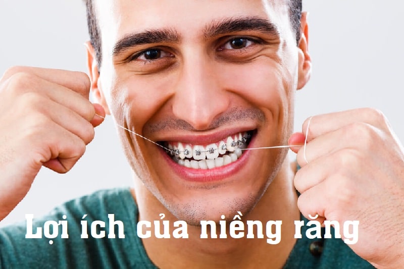 Lợi ích của niềng răng