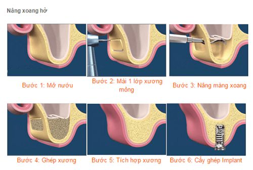 Hình ảnh nâng xoang hở