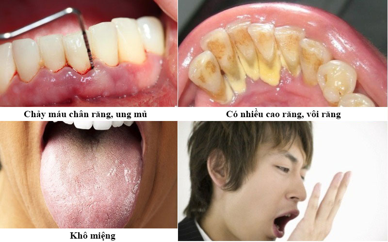 Nguyên nhân bệnh hôi miệng