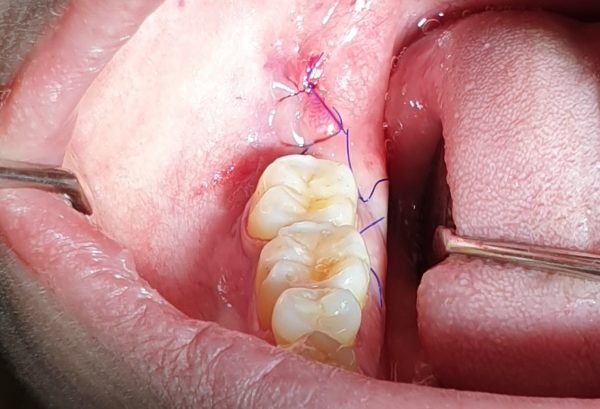 Nhiễm khuẩn sau khi nhổ răng khôn
