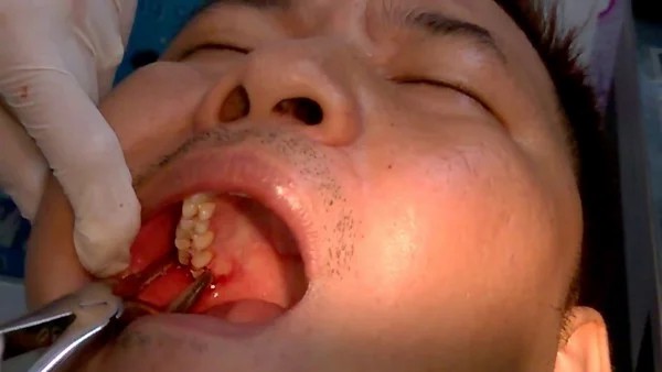Nhổ răng khôn hàm trên