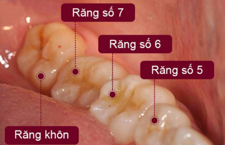 Nhổ răng số 8
