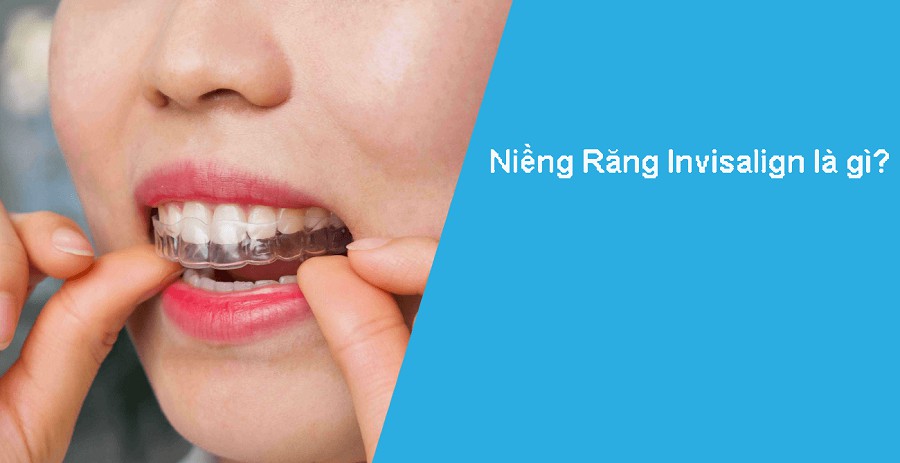 Niềng răng invisalign là gì