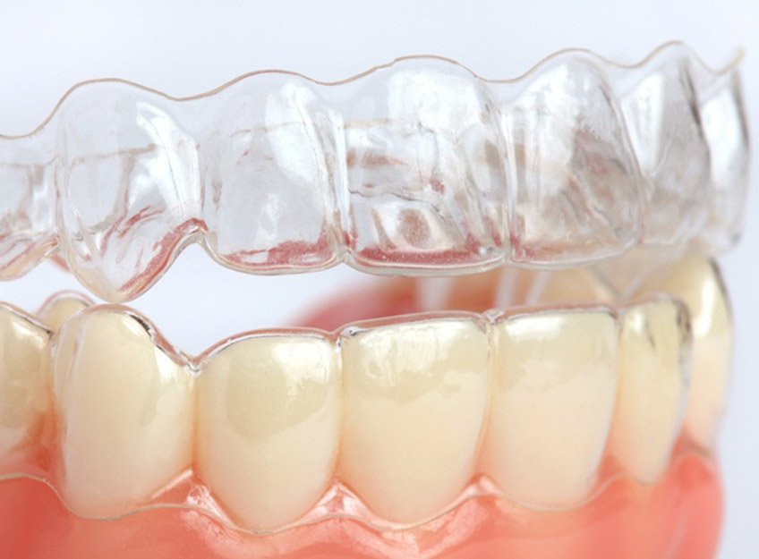 Niềng răng Clear Aligner
