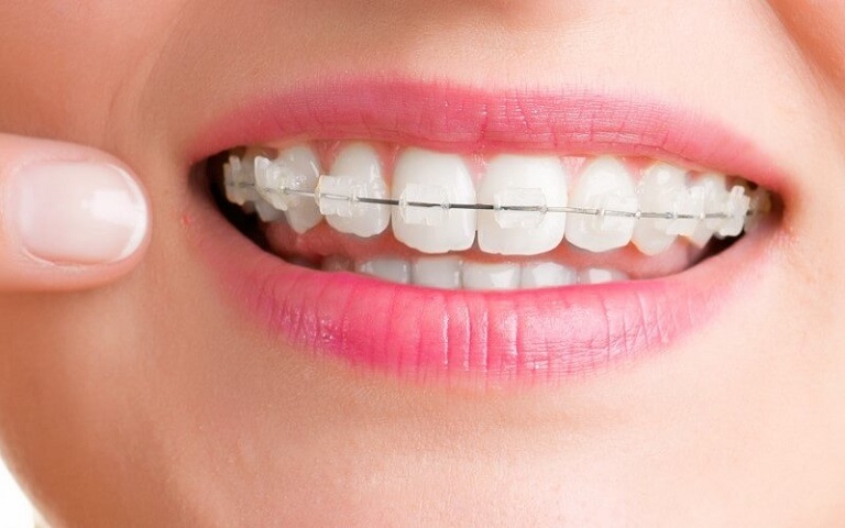 Niềng răng mắc cài sứ dây kim loại