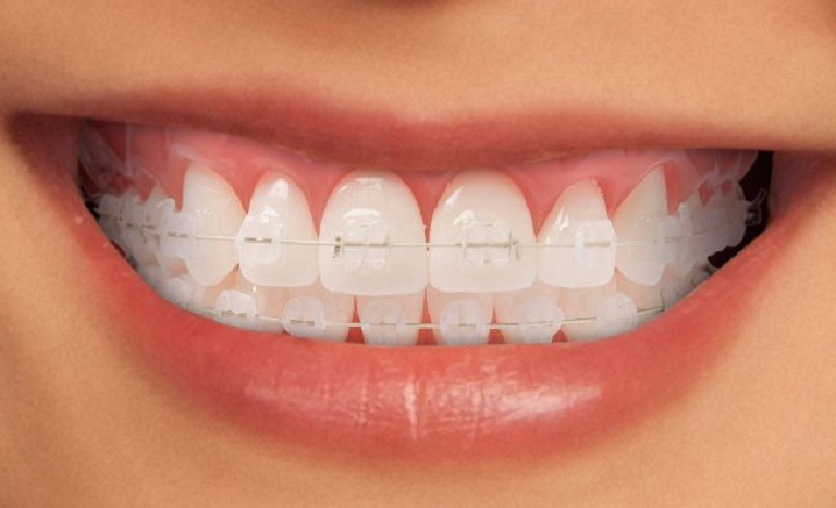 Niềng răng mắc cài sứ