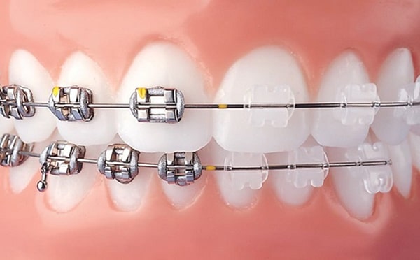 Niềng răng mắc cài truyền thống và mắc cài sứ