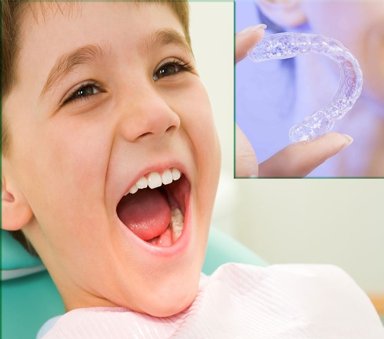 Niềng răng trong suốt Invisalign trẻ em