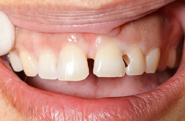 Trường hợp răng cửa bị sâu