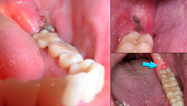 Răng khôn bị nhiễm trùng