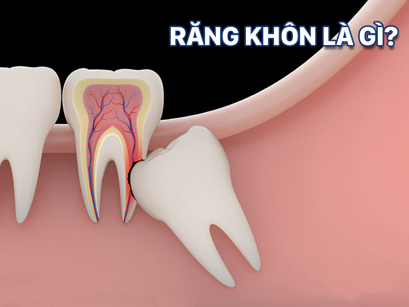 Răng khôn là