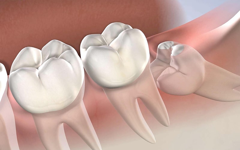 Răng khôn mọc lệch về phía trước