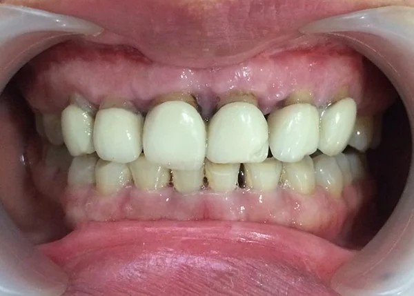 Bọc răng sứ giá rẻ