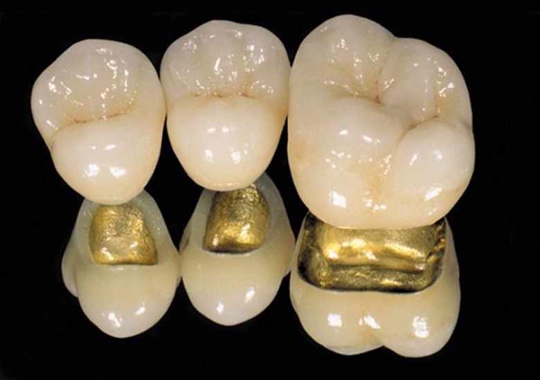 Răng sứ kim loại quý đẹp