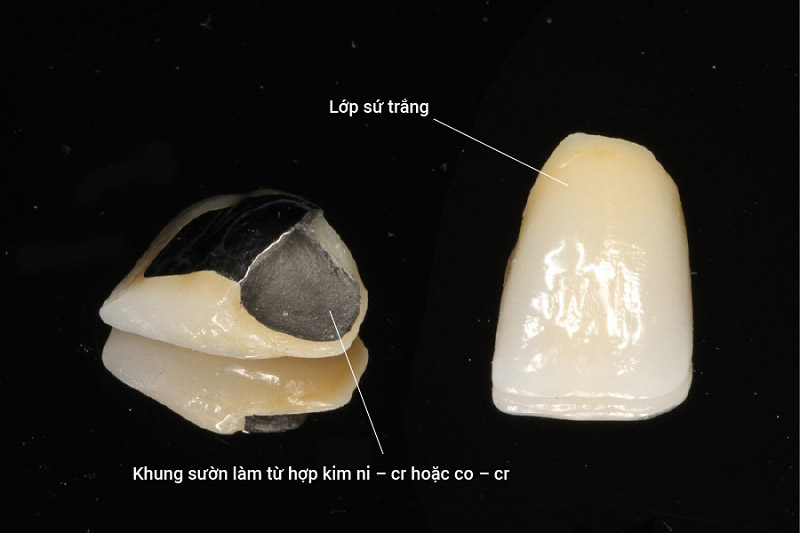 Răng sứ kim loại thường